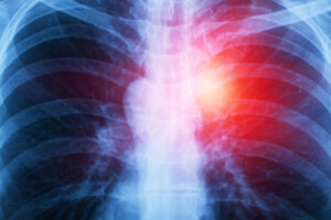 Warning Signs of Mesothelioma and Asbestos Exposure