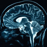 How common is Traumatic Brain Injury (TBI)?