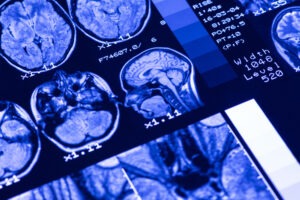 MRI brain scans