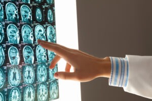 doctor-analyzing-brain-scan-for-damage